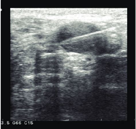 lymph node biopsy results inconclusive|Lymph node biopsy guided by ultrasound .